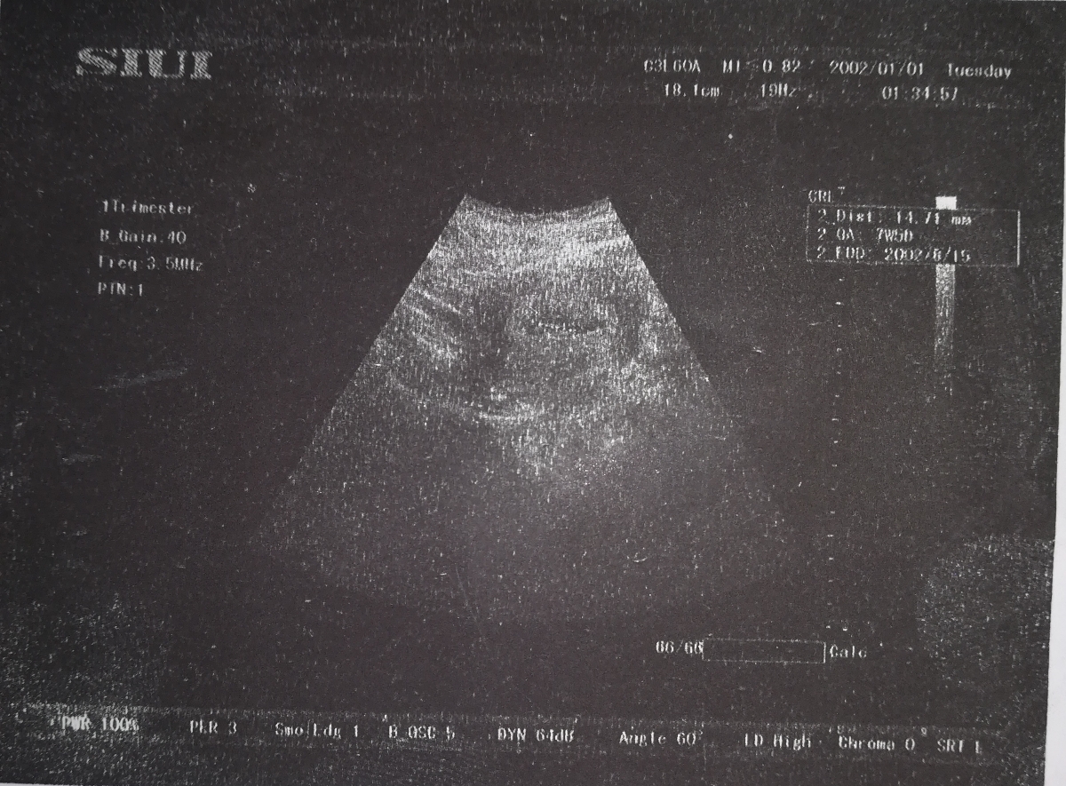 سلام رفتم سونو گفت فیبروم دارم 😢😢😢