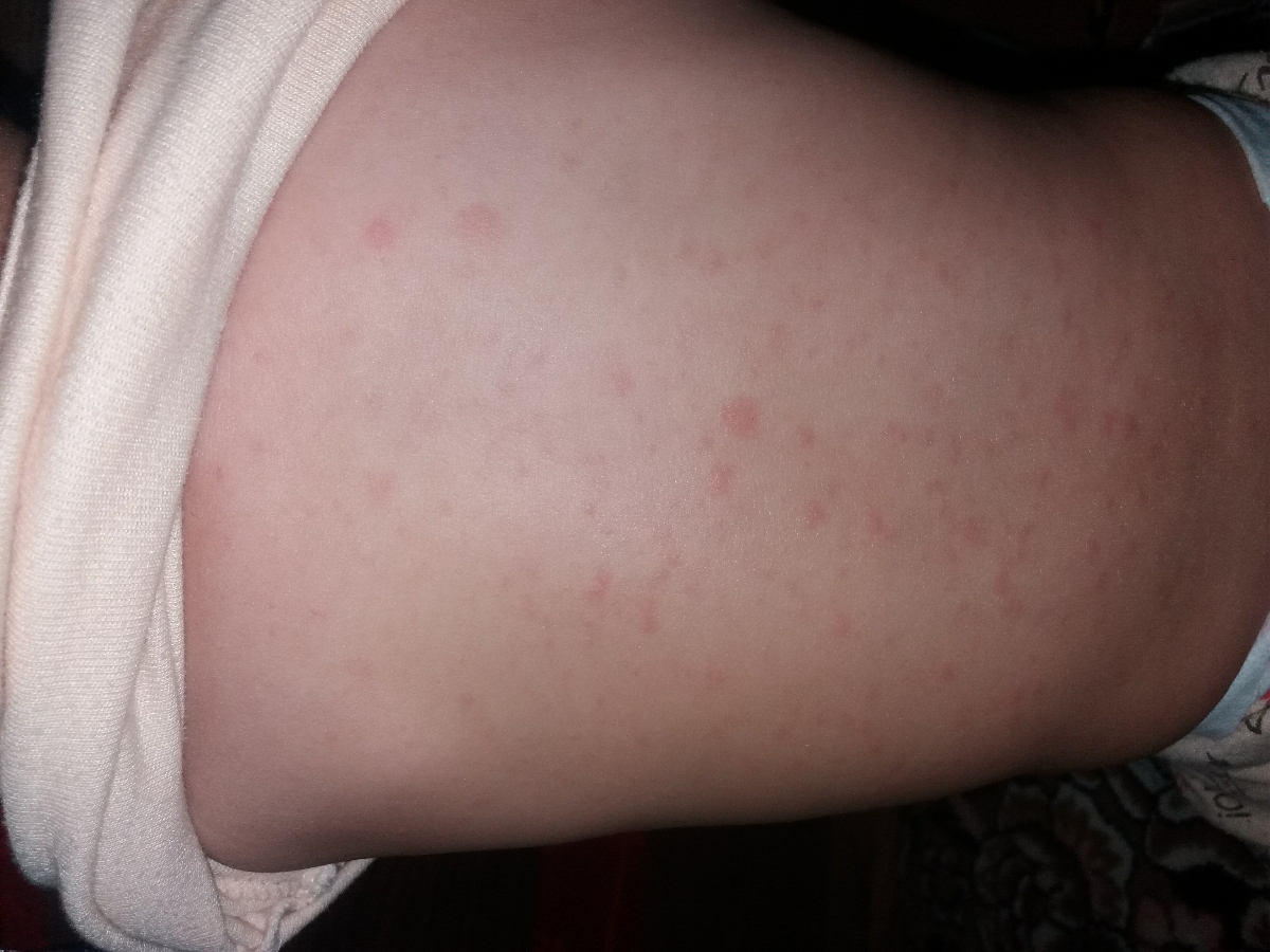 ایا این سرخک است