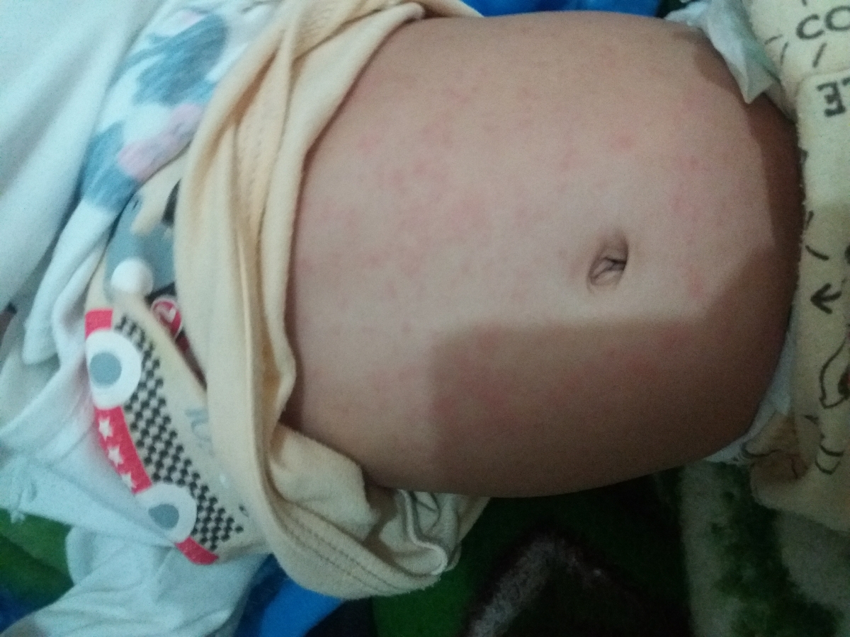 ایا این سرخک است