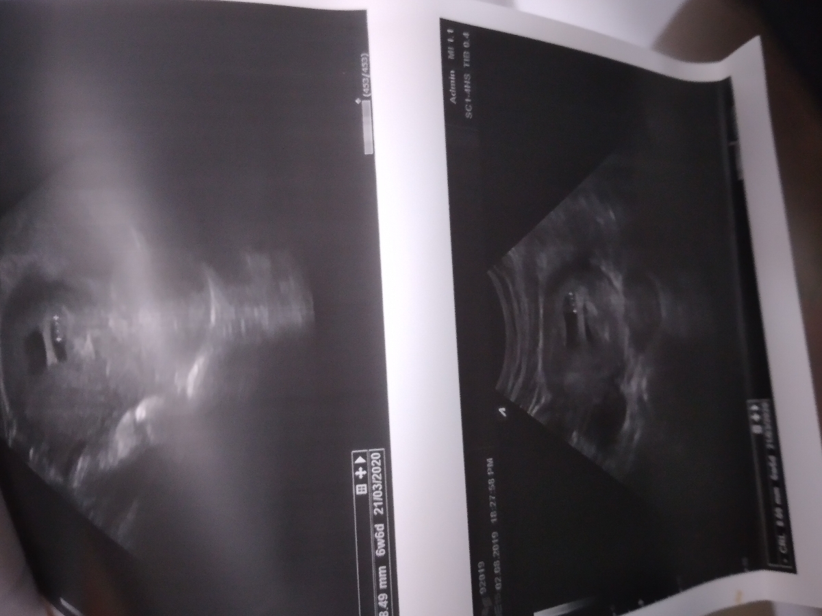 سلام بچهاوخانم دکتررفتم سونوبهم گف دوقلوئه😍😍😍ودوتاکیسه ی جداست الان عکسشومیزارم