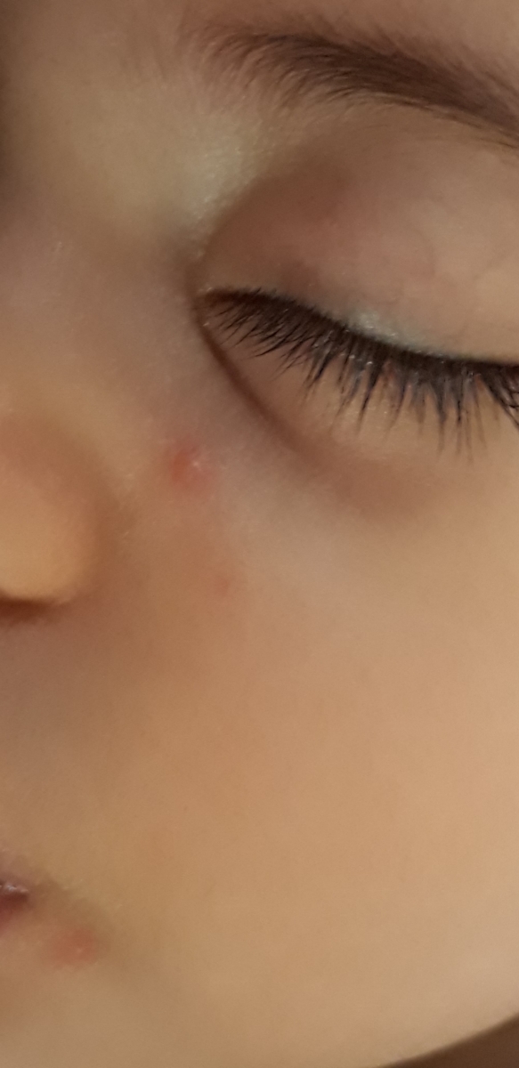 زدن مرتب دانه های قرمز روی صورت کودک ۱۱ ماهه زدن مرتب دانه های قرمز روی صورت کودک ۱۱ ماهه