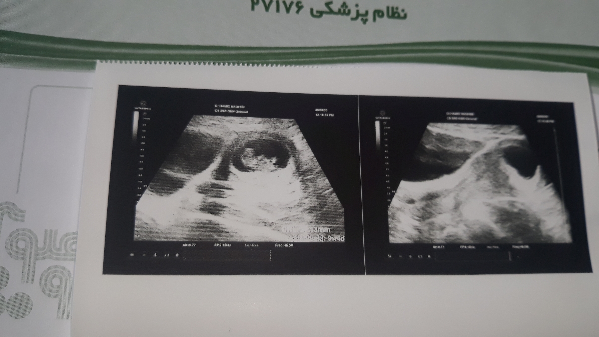 سونوگرافی وضعیت و سلامت جنین