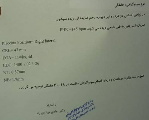شرح سونوی ان تی