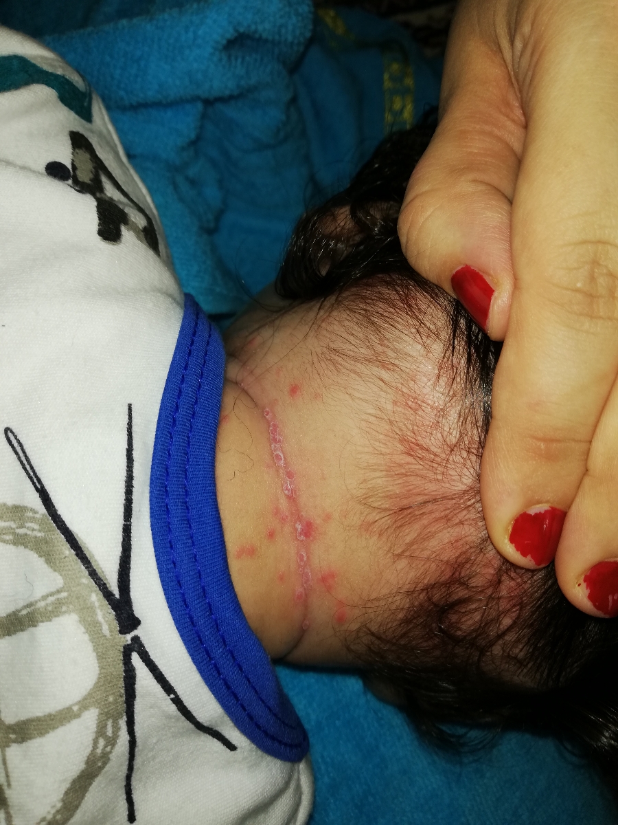 بدنم نوزادم دونه های عجیب زده علتش چیه