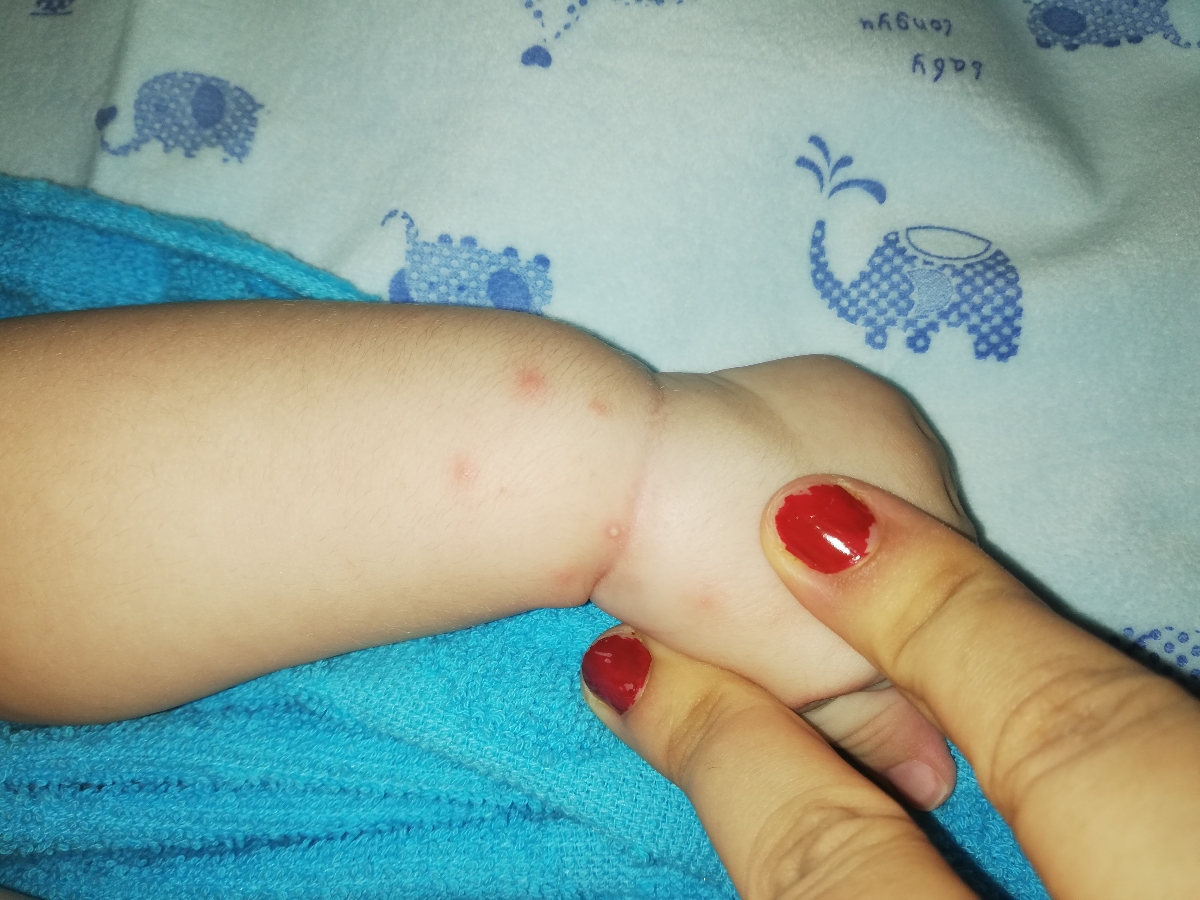 بدنم نوزادم دونه های عجیب زده علتش چیه