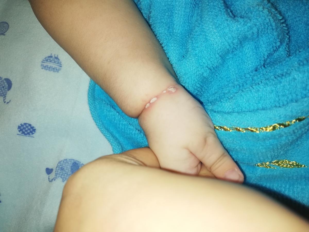 بدنم نوزادم دونه های عجیب زده علتش چیه