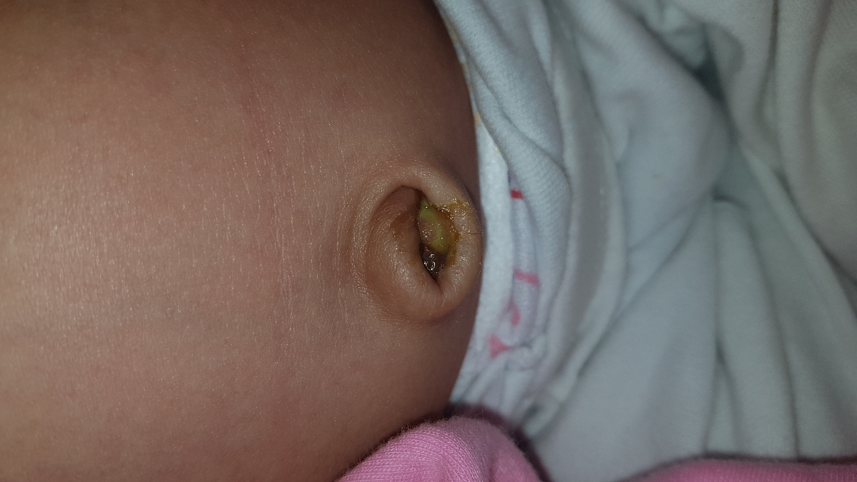 ناف نوزاد و طیعی یا غیرطبیعی بودن آن