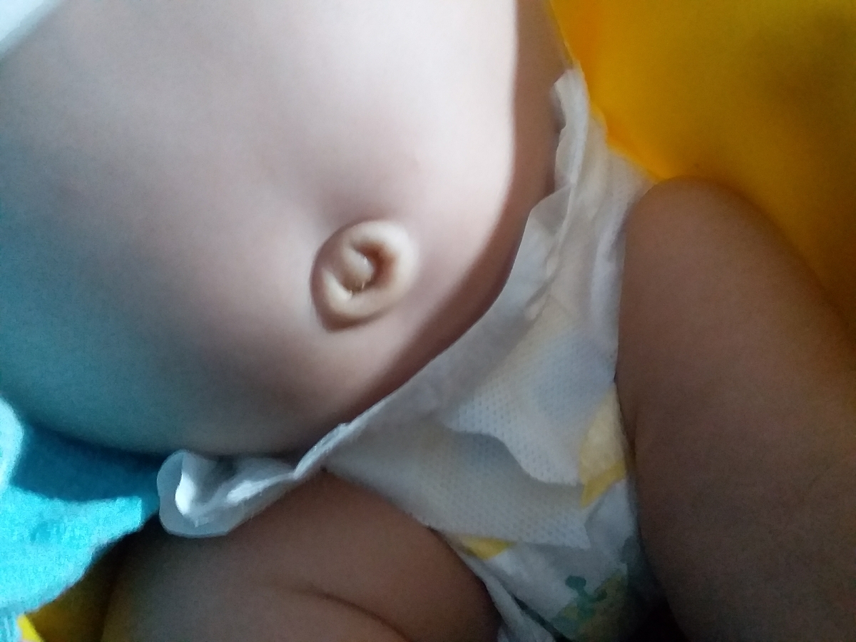 ناف نوزاد و طیعی یا غیرطبیعی بودن آن