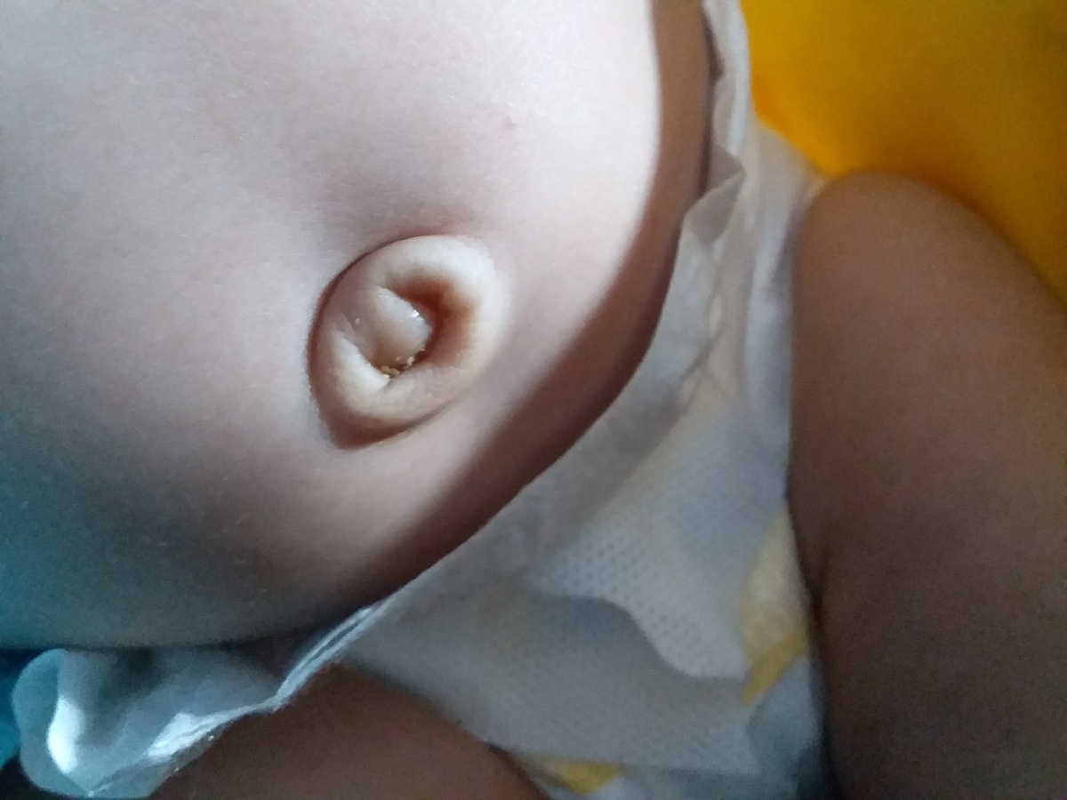 ناف نوزاد و طیعی یا غیرطبیعی بودن آن