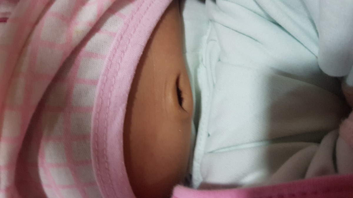 ناف نوزاد و طیعی یا غیرطبیعی بودن آن