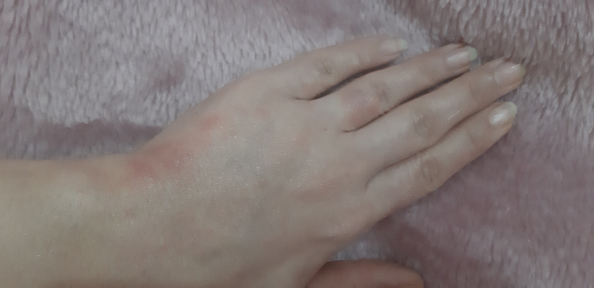 پماد فلوئوسینول برای اگزمای رو دست میتونم استفاده کنم؟ اگه نه غیر این پماد چی میتونم بزنم بی ضرر باشه پماد فلوئوسینول برای اگزمای رو دست میتونم استفاده کنم؟ اگه نه غیر این پماد چی میتونم بزنم بی ضرر باشه