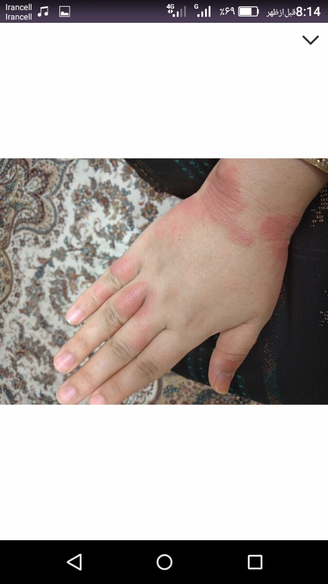 پماد فلوئوسینول برای اگزمای رو دست میتونم استفاده کنم؟ اگه نه غیر این پماد چی میتونم بزنم بی ضرر باشه پماد فلوئوسینول برای اگزمای رو دست میتونم استفاده کنم؟ اگه نه غیر این پماد چی میتونم بزنم بی ضرر باشه