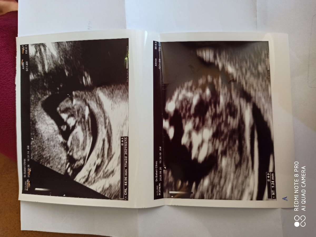 جواب سونو ان تی غربالگری اول جواب سونو ان تی غربالگری اول