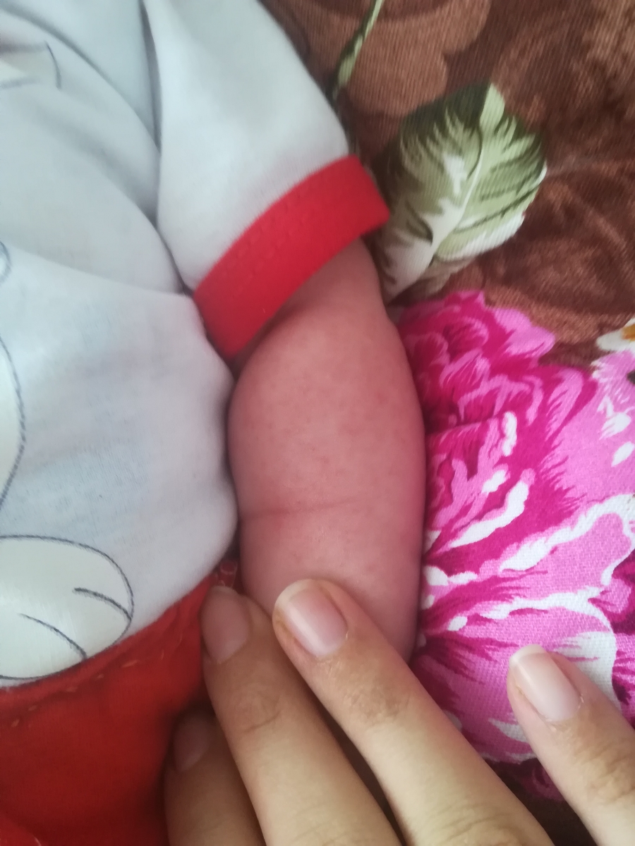 عرق سوز شدن نی نی یا حساسیت عرق سوز شدن نی نی یا حساسیت