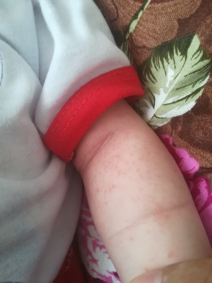 عرق سوز شدن نی نی یا حساسیت عرق سوز شدن نی نی یا حساسیت