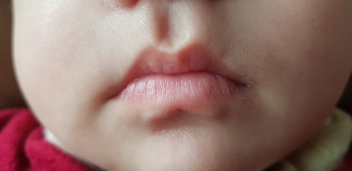 سلام موی بدن دخترم تیکه تیکه داره در میاد میخام ببینم طبیعیه؟ سلام موی بدن دخترم تیکه تیکه داره در میاد میخام ببینم طبیعیه؟