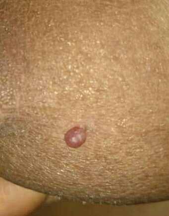 جوش روی سینه در بارداری جوش روی سینه در بارداری