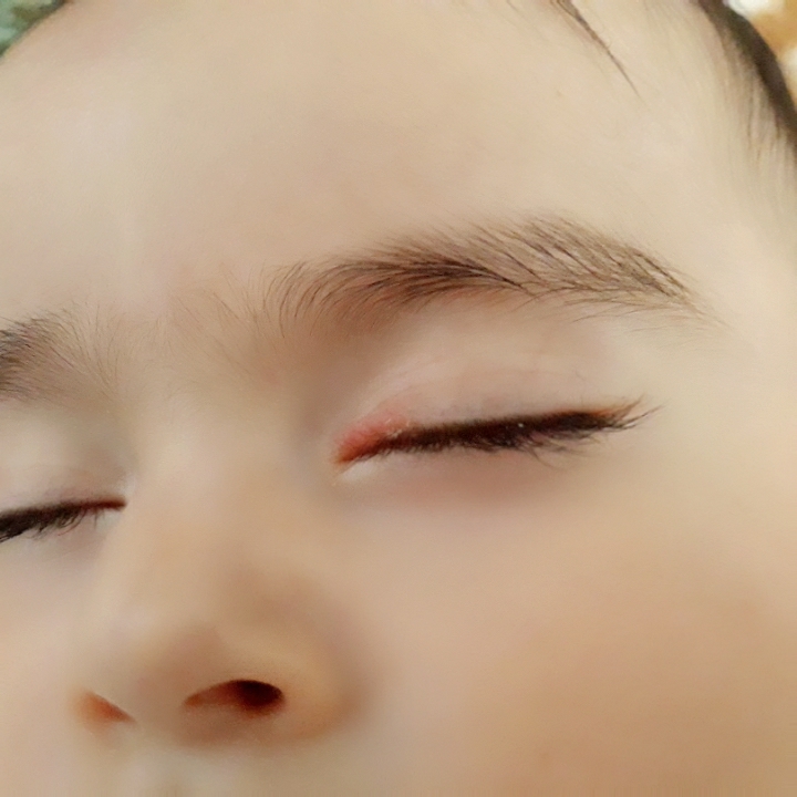 خارش و جوش چشم نوزاد