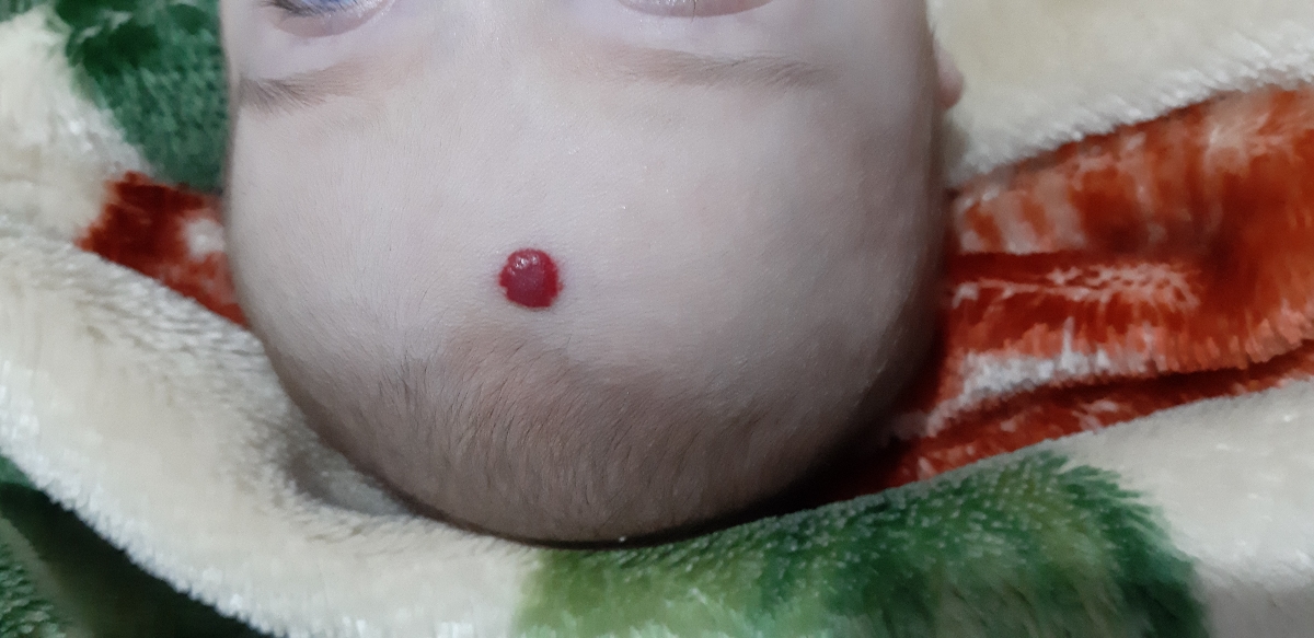 پیشانی نوزاد دو ماهه