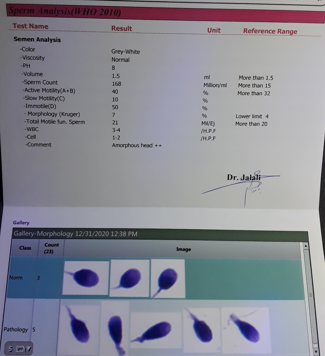 آزمایش اسپرم همسرم رو خانومای اومایی میشه ببینید