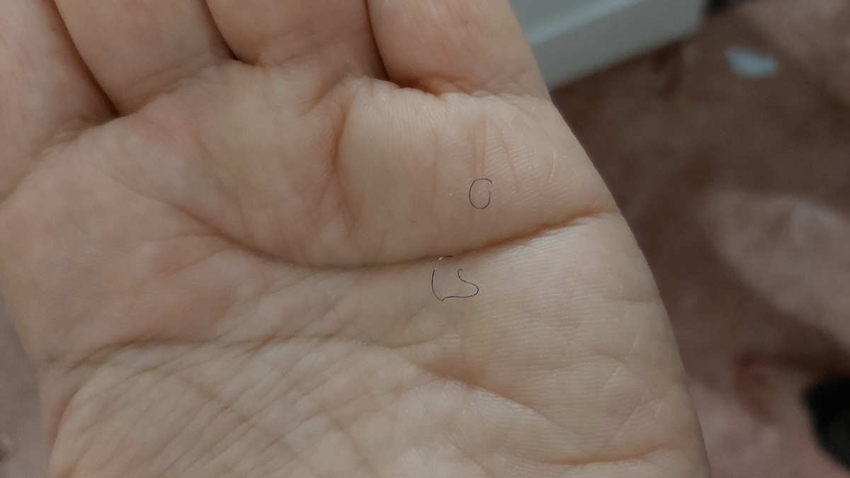 📌📌📌تشخیص نوع بخیه عمل بینی📍📍📍