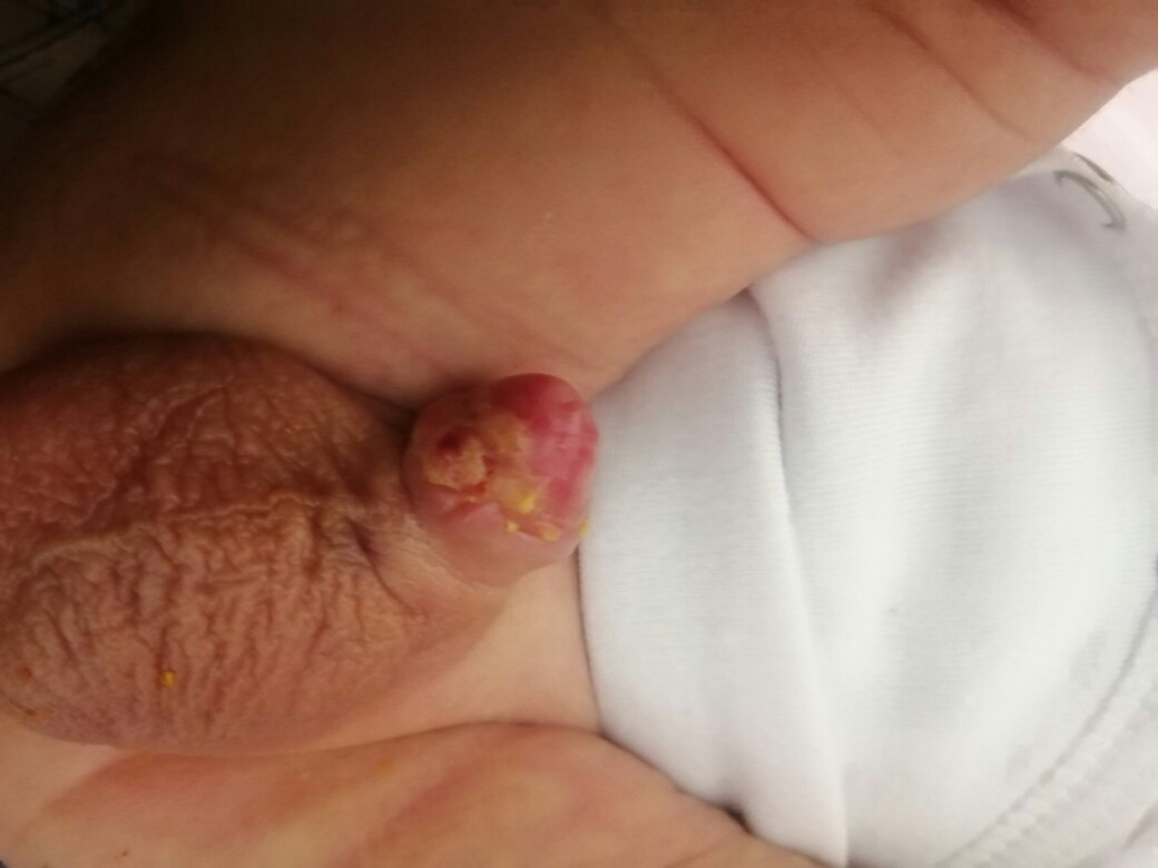 عوارض ختنه زود هنگام