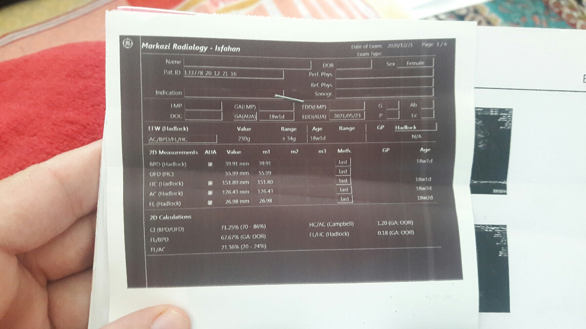سونوی انومالی و تعیین جنسیت