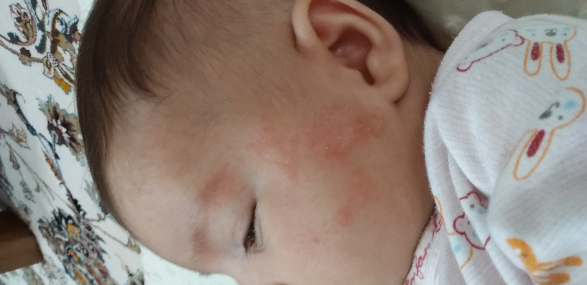 صورت دخترم اینجوری قرمز شده 
هردو طرف صورتش سمت گوشاش اینجوری شده برا چیه چی کار کنم خوب بشه