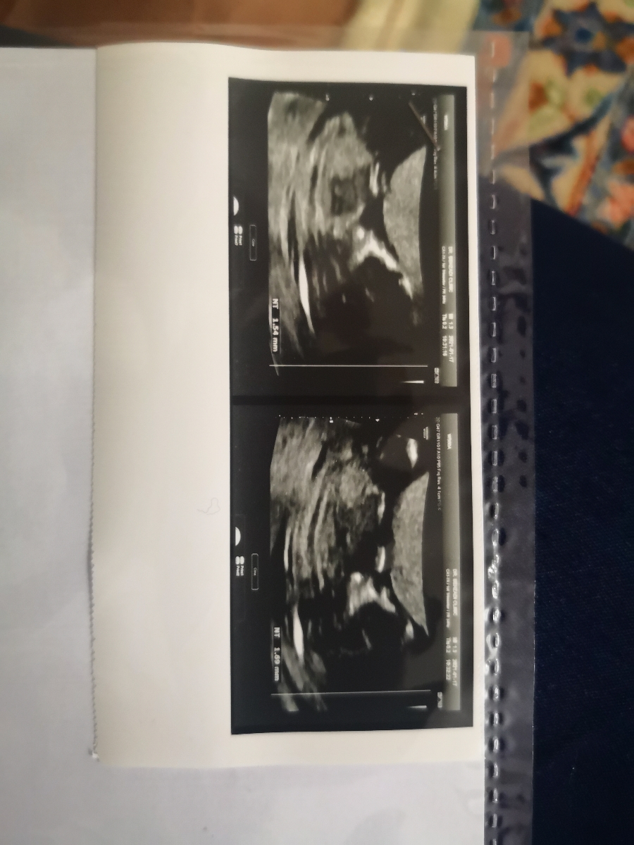 تفسیر سونوی ان تی و تشخیص جنسیت