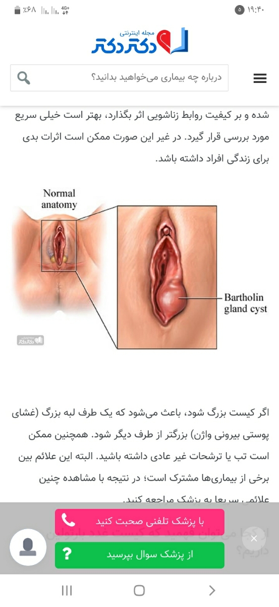 توده سفت در ناحیه تناسلی