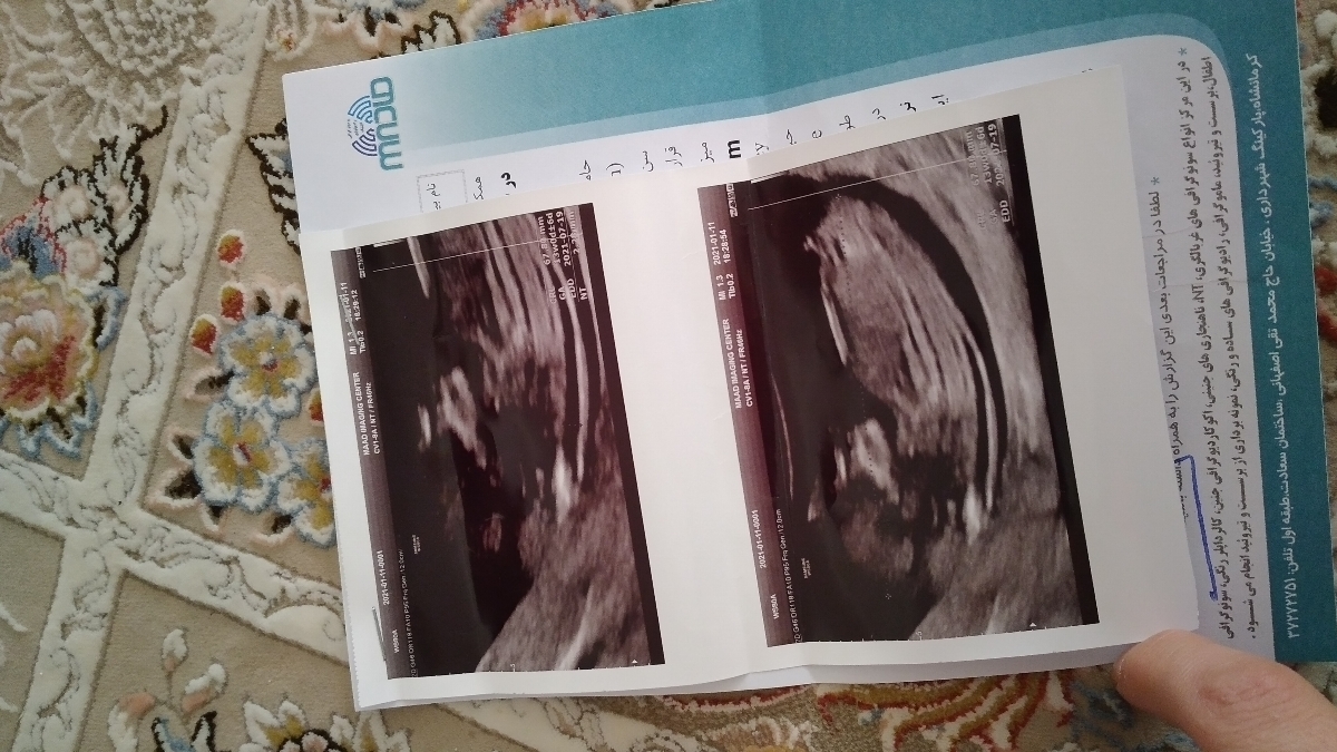 تفسیر آزمایش وسونوی غربالگری