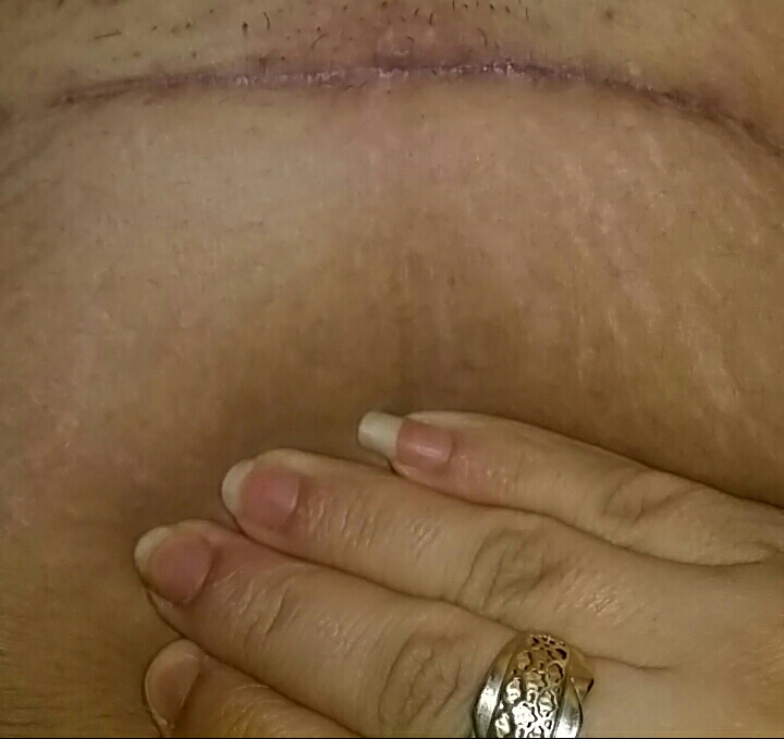 خط بخیه سزارینم خیلی میخاره خط بخیه سزارینم خیلی میخاره