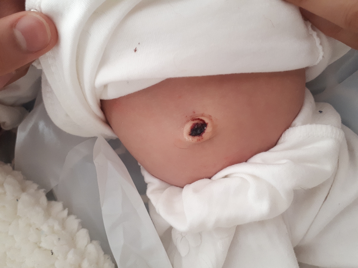 علت خون اومدن ناف نوزاد چند روز بعد از افتادن بند نافش علت خون اومدن ناف نوزاد چند روز بعد از افتادن بند نافش