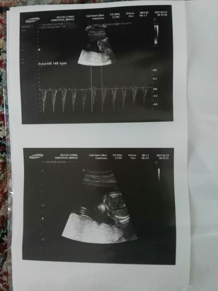 اکوی قلب جنین و گرفتگی بطن راست