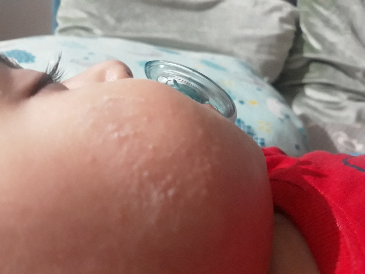 جوش صورت نوزادیک ساله