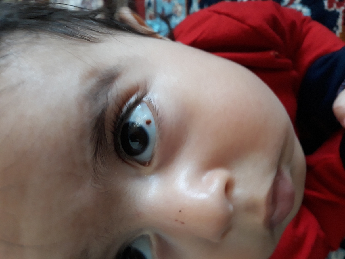 زخم شدن چشم نوزاد