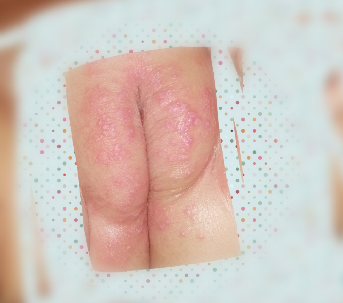 سوختگی شدید پای کودک