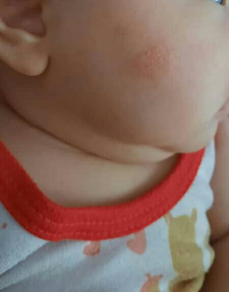 صورت دخترم دونه زده