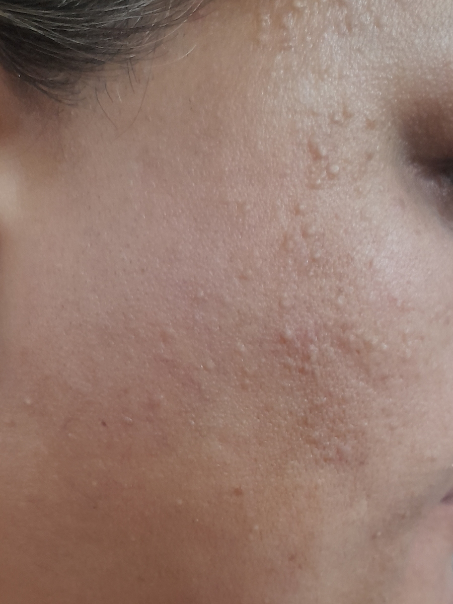 جوش زیرپوستی سر سفید صورت