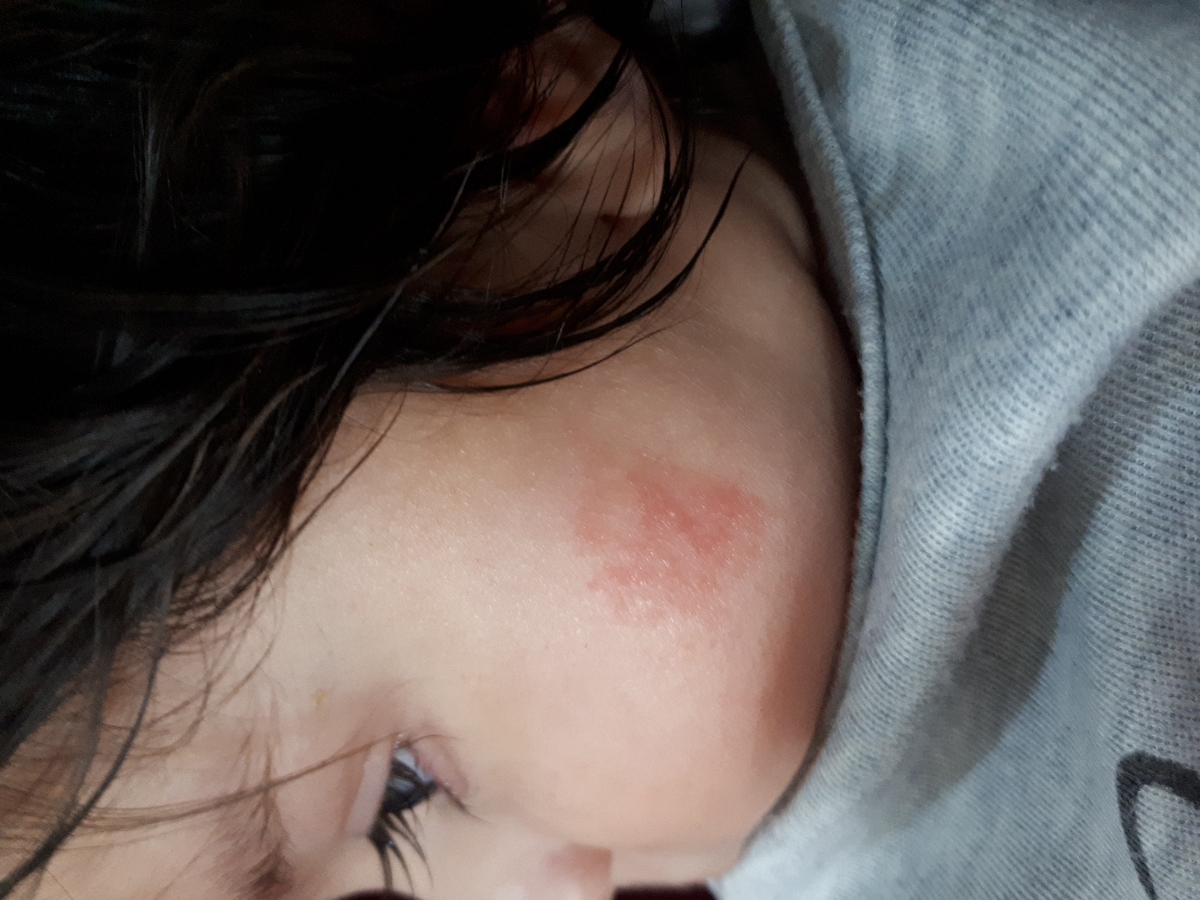 جوش ریز کنار صورت پسرم جوش ریز کنار صورت پسرم