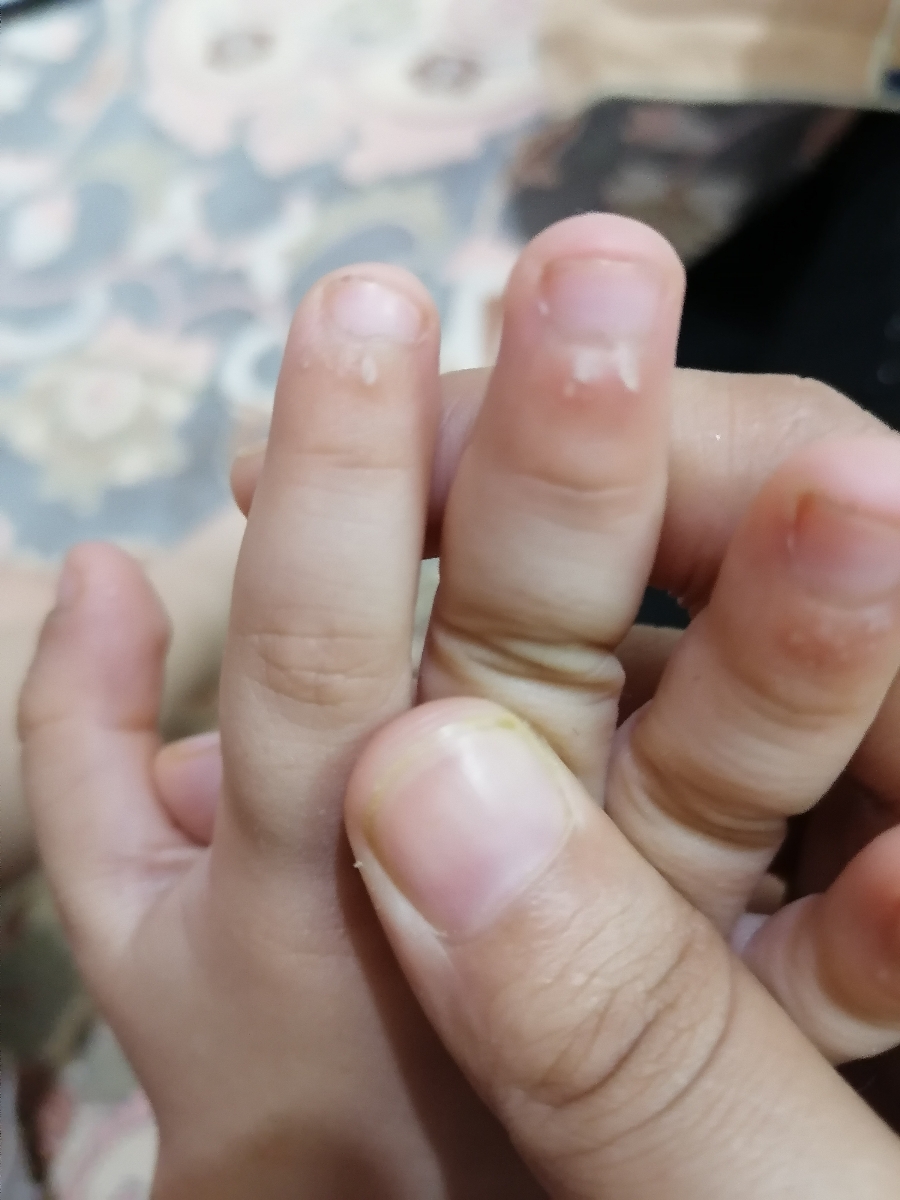 سلام خانم دکترپسرم پنج سالشه. بعصی از انگشت های دستش پوست زیر ناخنش سفید شده
