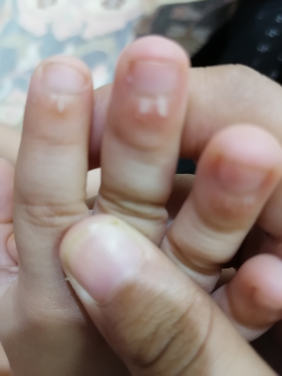 سلام خانم دکترپسرم پنج سالشه. بعصی از انگشت های دستش پوست زیر ناخنش سفید شده