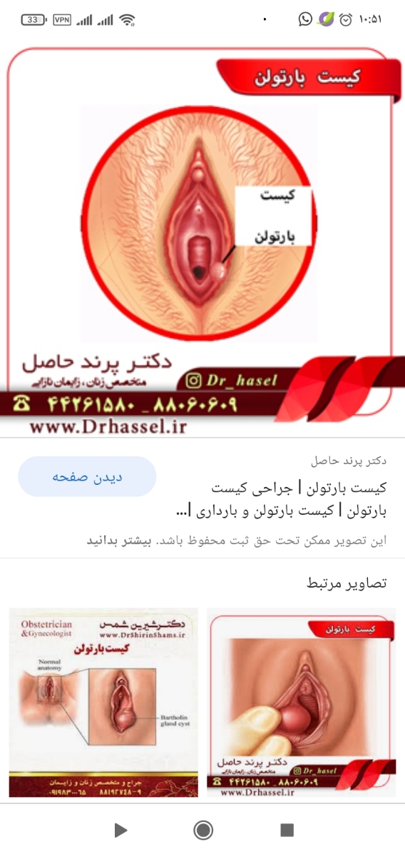 برامدگی زیر پوست مثل جوش کنار واژن برامدگی زیر پوست مثل جوش کنار واژن