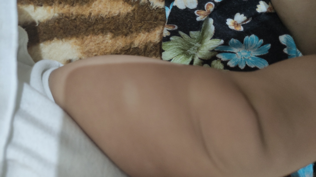 لکه سفید روی رونه پا دخترم