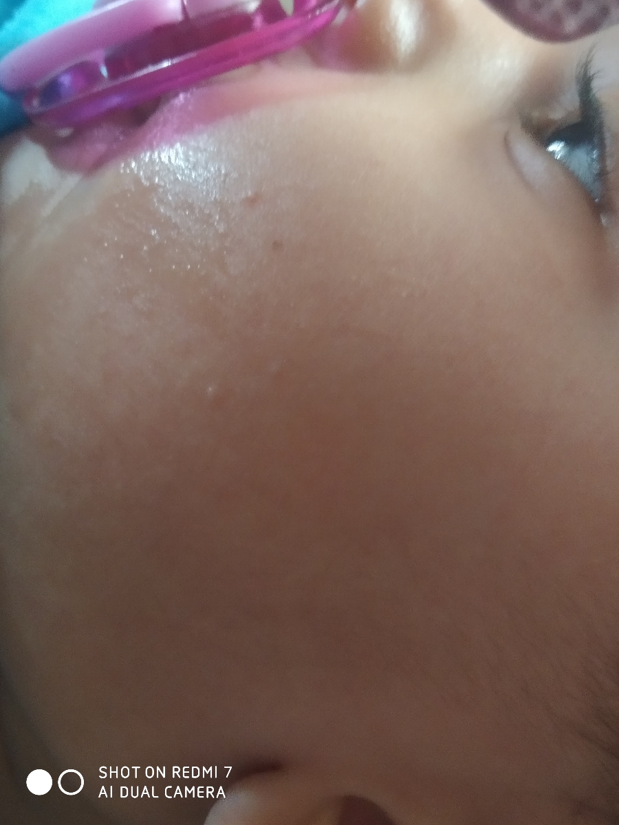سلام خانم دکتر لطفا صورت پسرم رو نگاه کنید جوش زده