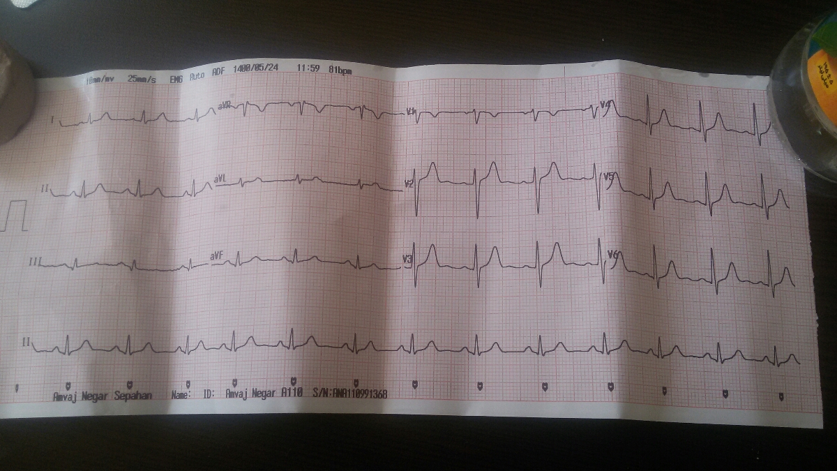 نوار قلب رو تفسیر کنید