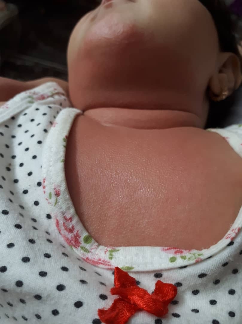 قرمزی گردن و بدن دخترم قرمزی گردن و بدن دخترم