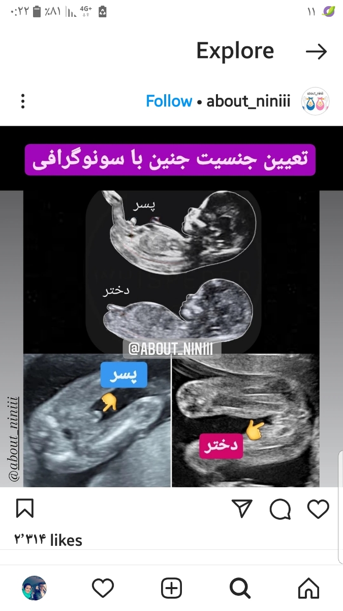 آیا جنسیت جنین در هفته سیزدهم از طریق سونوگرافی صحیح ااست؟ آیا جنسیت جنین در هفته سیزدهم از طریق سونوگرافی صحیح ااست؟