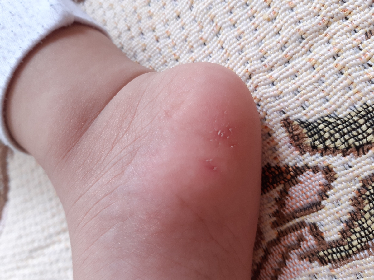 جوش صورت و ترک پا