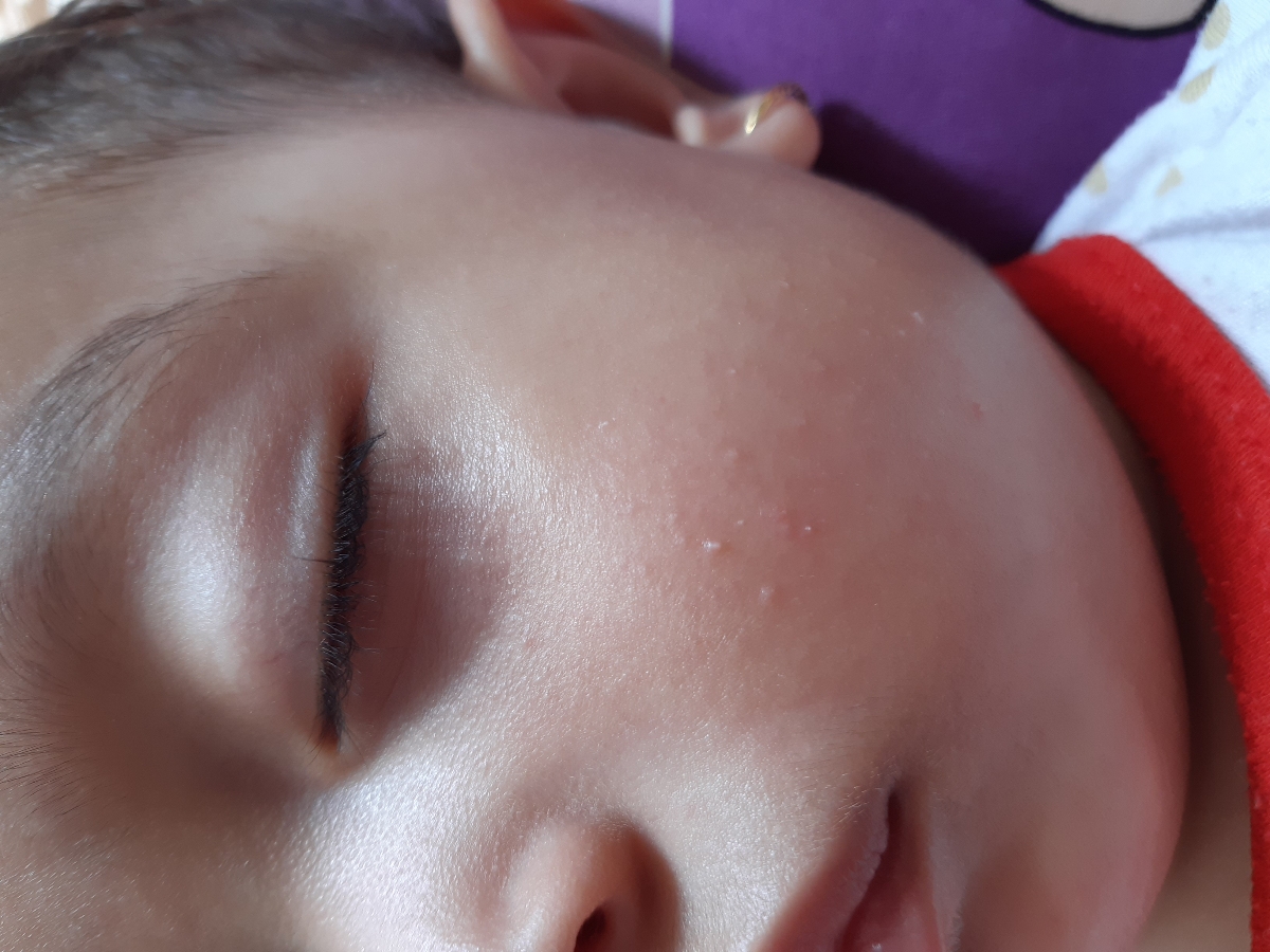 جوش صورت و ترک پا